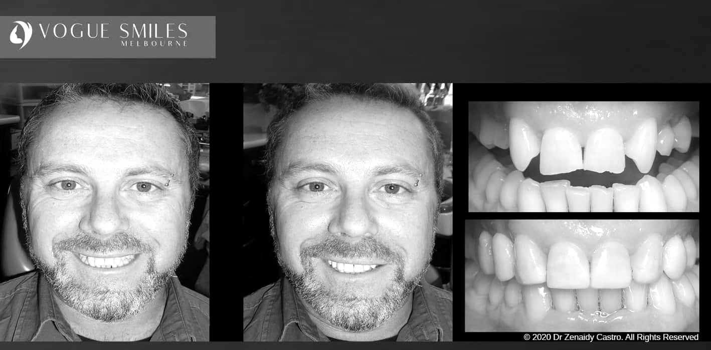 Composite Veneers | Resin Bonding Teeth | Teeth Veneers Melbourne Composite Veneers | Resin Bonding Teeth | Teeth Veneers Melbourne