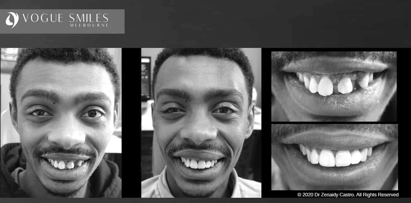 Composite Veneers | Resin Bonding Teeth | Teeth Veneers Melbourne Composite Veneers | Resin Bonding Teeth | Teeth Veneers Melbourne