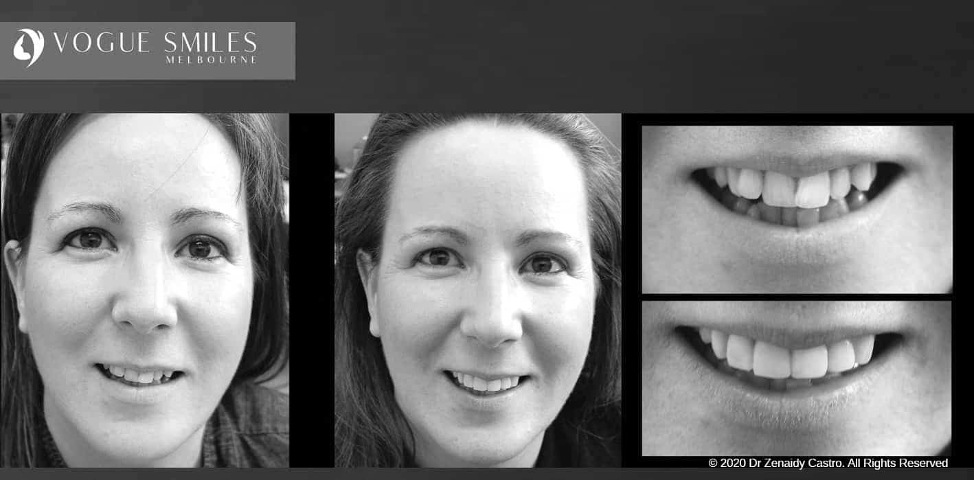 Composite Veneers | Resin Bonding Teeth | Teeth Veneers Melbourne Composite Veneers | Resin Bonding Teeth | Teeth Veneers Melbourne