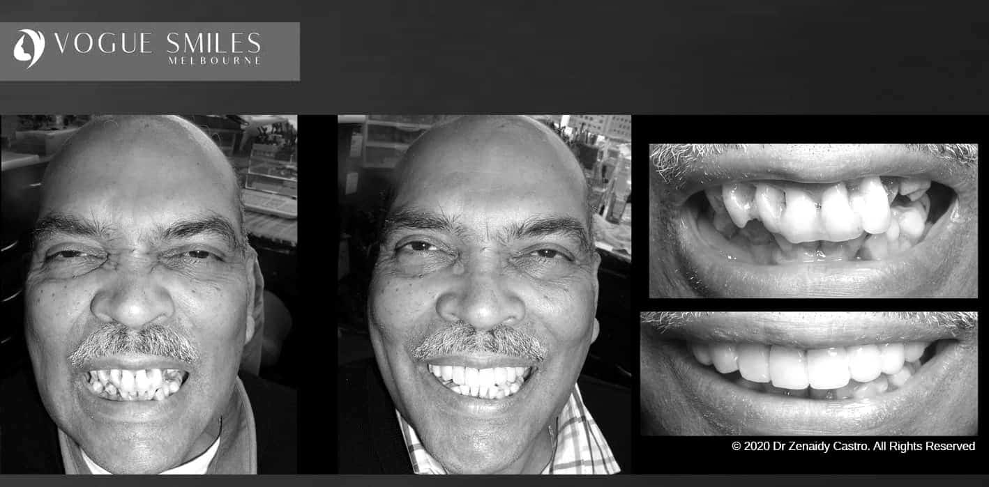Composite Veneers | Resin Bonding Teeth | Teeth Veneers Melbourne Composite Veneers | Resin Bonding Teeth | Teeth Veneers Melbourne