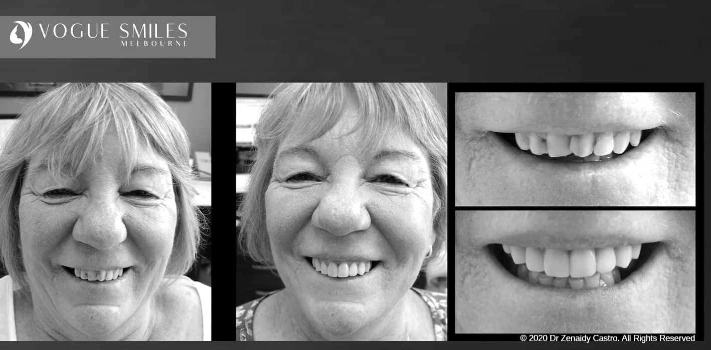 Composite Veneers | Resin Bonding Teeth | Teeth Veneers Melbourne