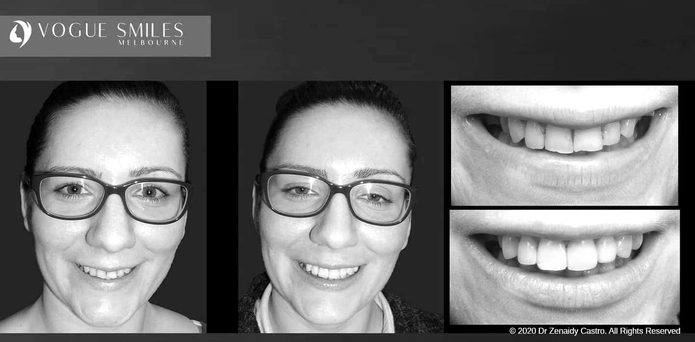 Composite Veneers | Resin Bonding Teeth | Teeth Veneers Melbourne Composite Veneers | Resin Bonding Teeth | Teeth Veneers Melbourne