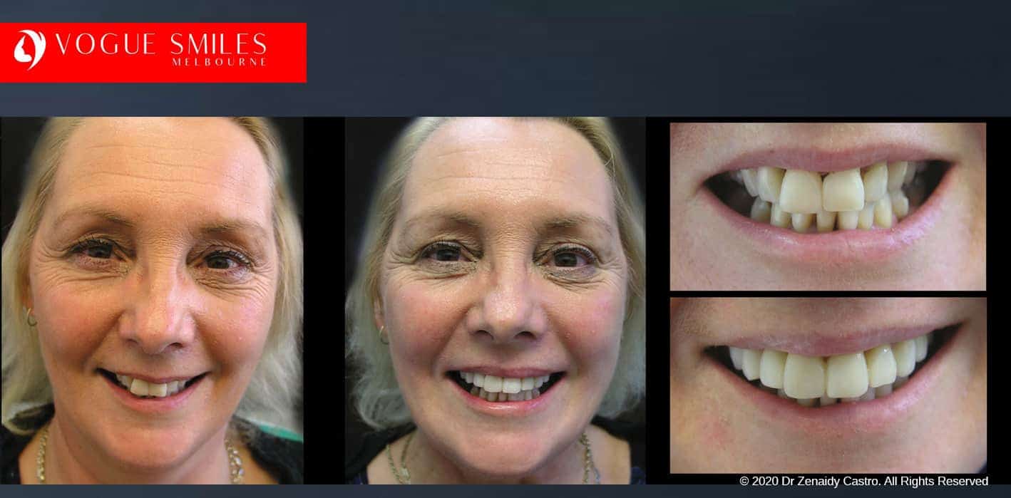 Dental Bonding Melbourne | Improve Smiles With Composite bonding