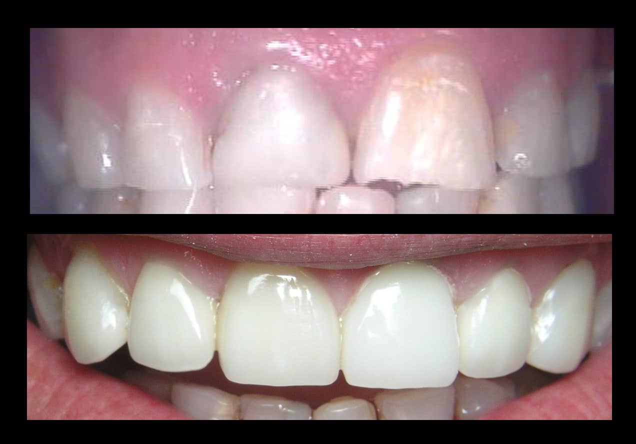 Fix and Repair Chipped tooth, Cracked & Broken Tooth