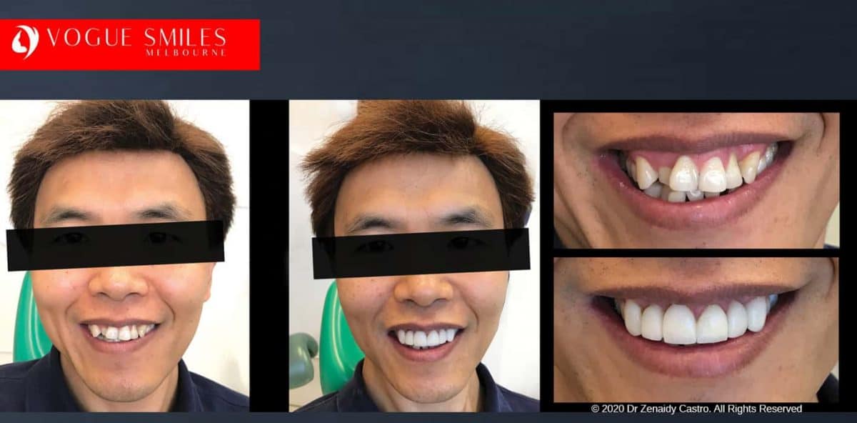 Overlapping, Crooked, Crowded teeth BEFORE AND AFTER PHOTOS WITH PORCELAIN VENEERS