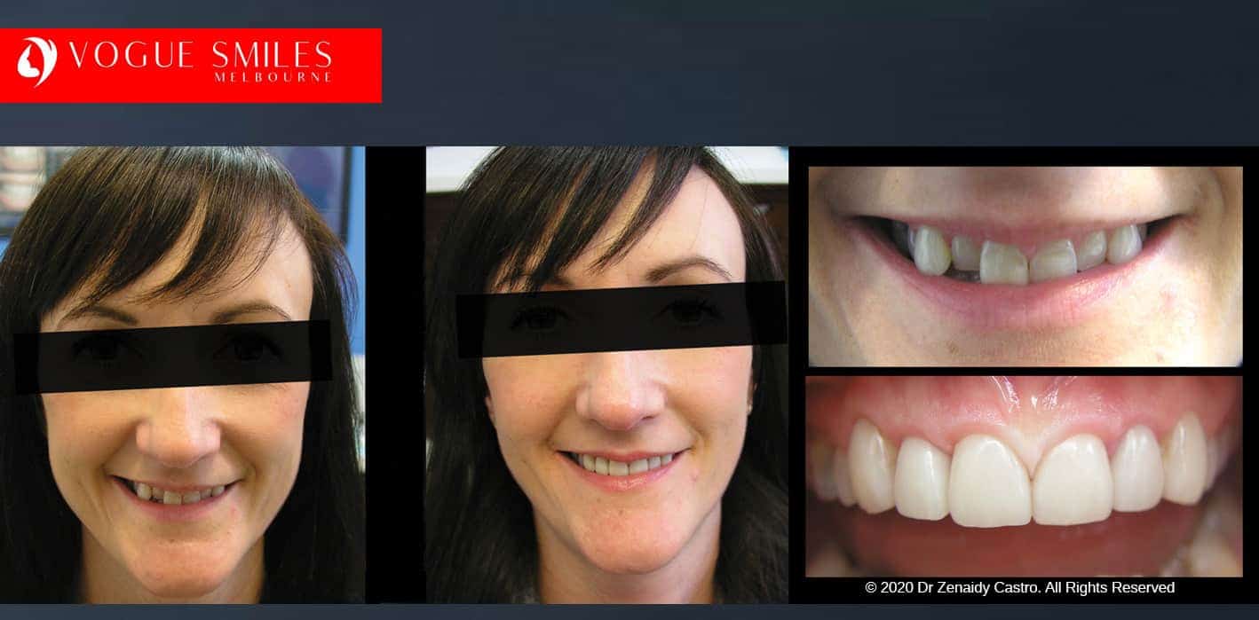  Overlapping, Crooked, Crowded teeth BEFORE AND AFTER PHOTOS WITH PORCELAIN VENEERS
