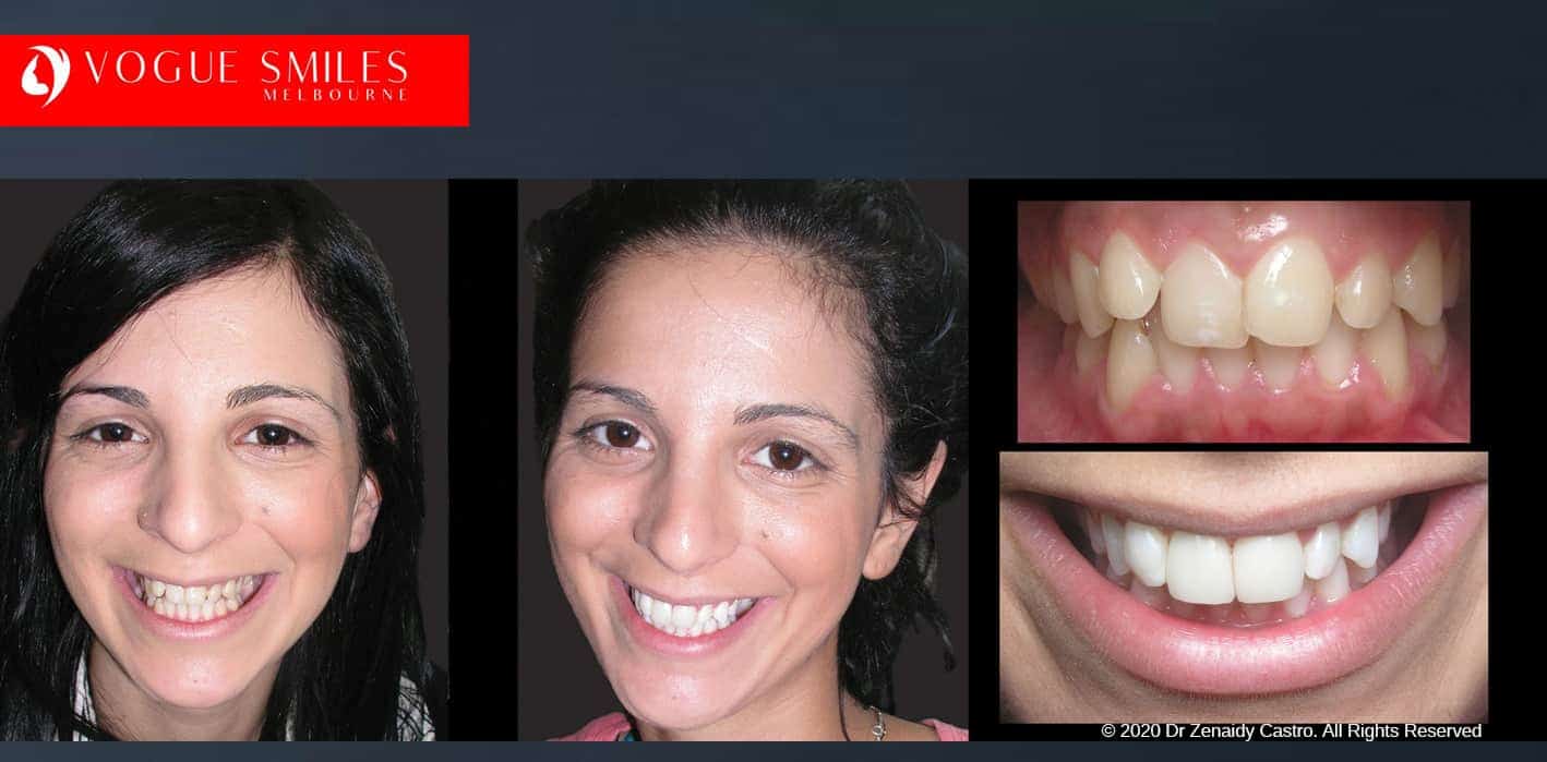  Overlapping, Crooked, Crowded teeth BEFORE AND AFTER PHOTOS WITH PORCELAIN VENEERS