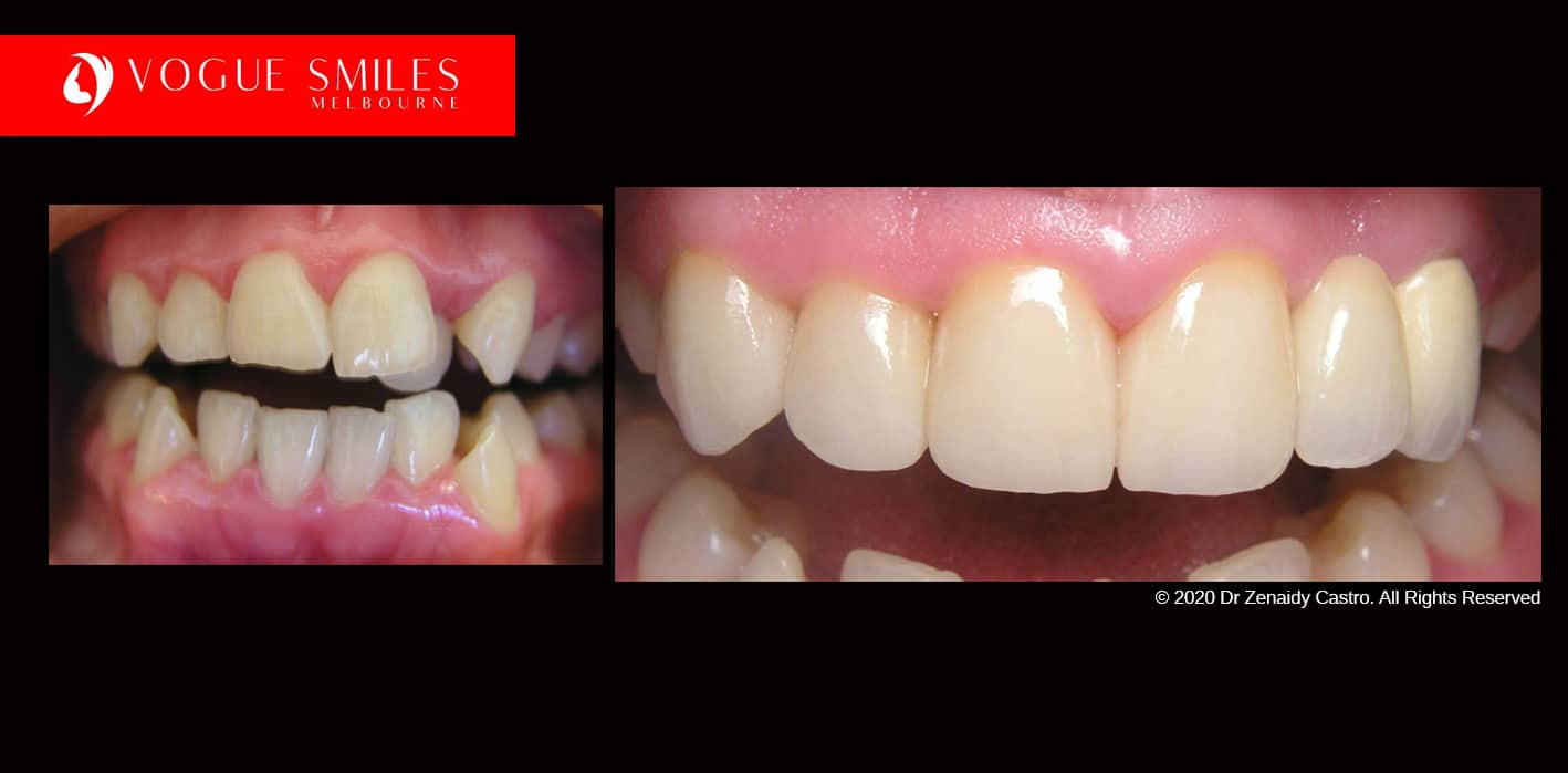 Fix and Straighten Overlapping, Crowded, Crooked teeth PORCELAIN VENEER 