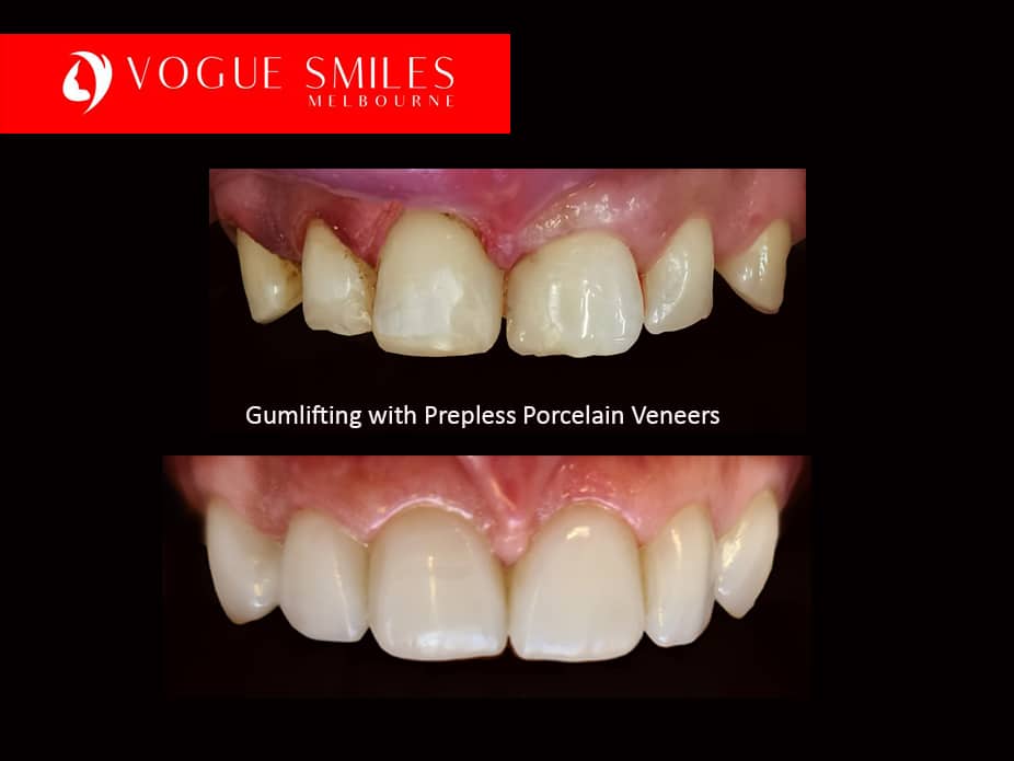How to Fix Small Teeth in Adults - Solutions for Small Teeth -Best Cosmetic Dentist in Melbourne CBD How to Fix Small Teeth in Adults - Solutions for Small Teeth -Best Cosmetic Dentist in Melbourne CBD