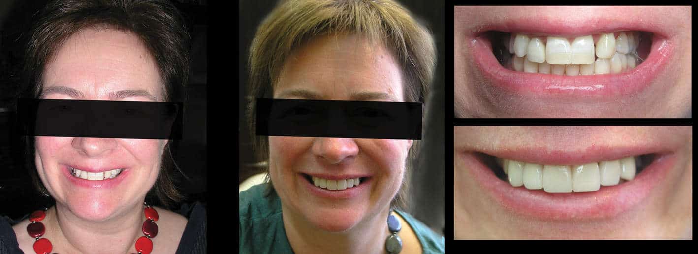 How to Fix Small Teeth in Adults - Solutions for Small Teeth -Best Cosmetic Dentist in Melbourne CBD How to Fix Small Teeth in Adults - Solutions for Small Teeth -Best Cosmetic Dentist in Melbourne CBD