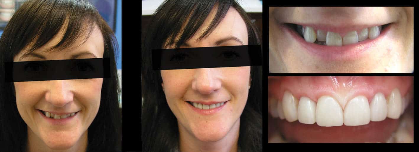 Fixing Short, Worn Down, Grinded down Teeth | Worn Teeth Treatment with Dental Veneers Melbourne CBD Cosmetic Dentistry Fixing Short, Worn Down, Grinded down Teeth | Worn Teeth Treatment with Dental Veneers Melbourne CBD Cosmetic Dentistry