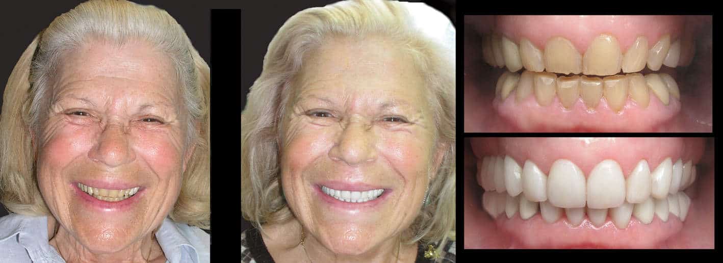 Permanent Teeth Whitening Treatment With Porcelain Veneers- MELBOURNE CBD COSMETIC DENTIST Permanent Teeth Whitening Treatment With Porcelain Veneers- MELBOURNE CBD COSMETIC DENTIST