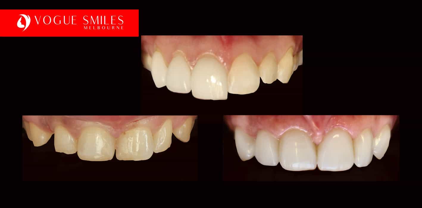 How to Fix Small Teeth in Adults - Solutions for Small Teeth -Best Cosmetic Dentist in Melbourne CBD How to Fix Small Teeth in Adults - Solutions for Small Teeth -Best Cosmetic Dentist in Melbourne CBD
