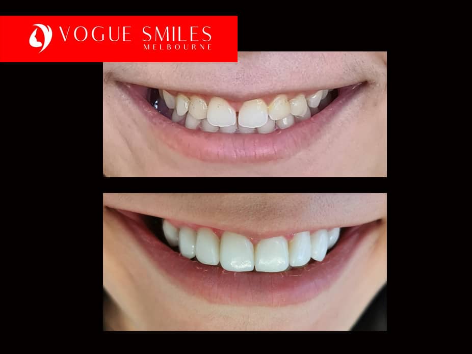 How to Fix Small Teeth in Adults - Solutions for Small Teeth -Best Cosmetic Dentist in Melbourne CBD