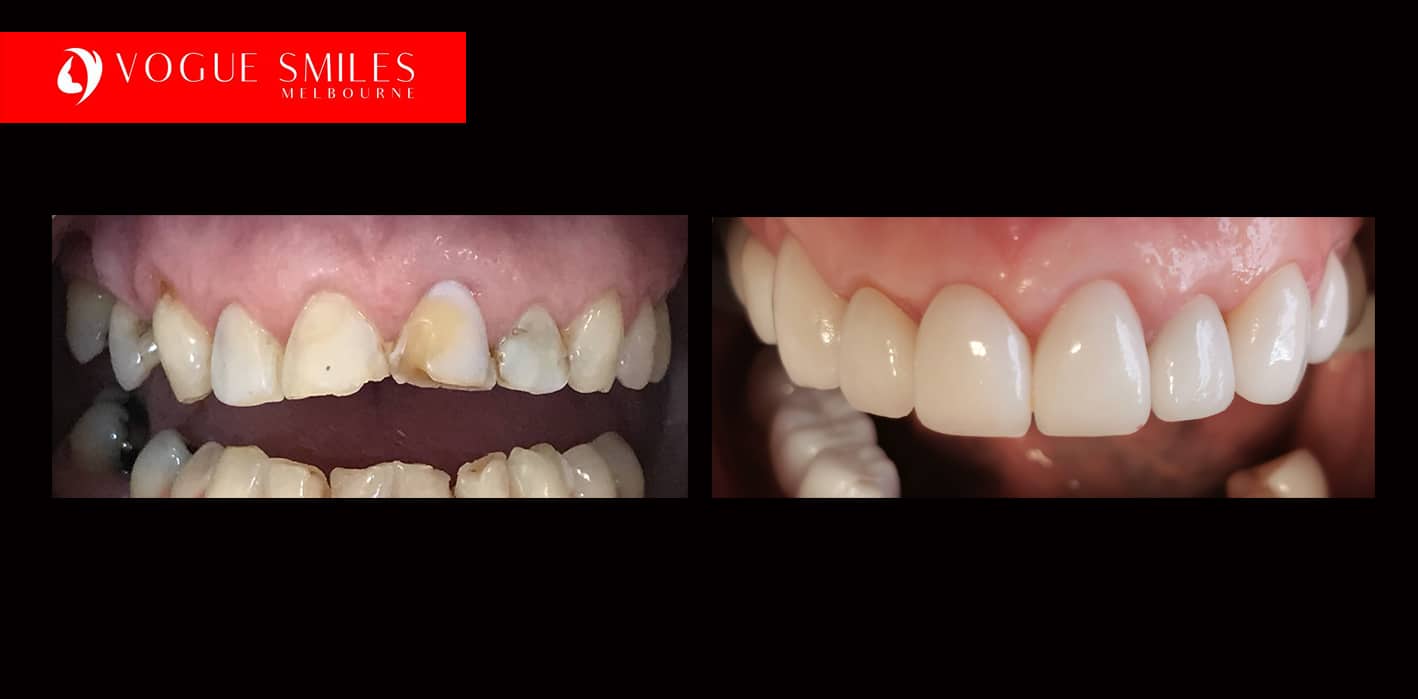 Fixing Short, Worn Down, Grinded down Teeth | Worn Teeth Treatment with Dental Veneers Melbourne CBD Cosmetic Dentistry