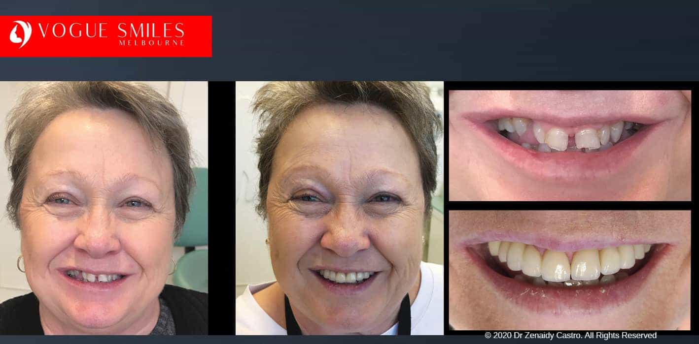Gappy Teeth Treatment in Melbourne with Porcelain Veneers 
