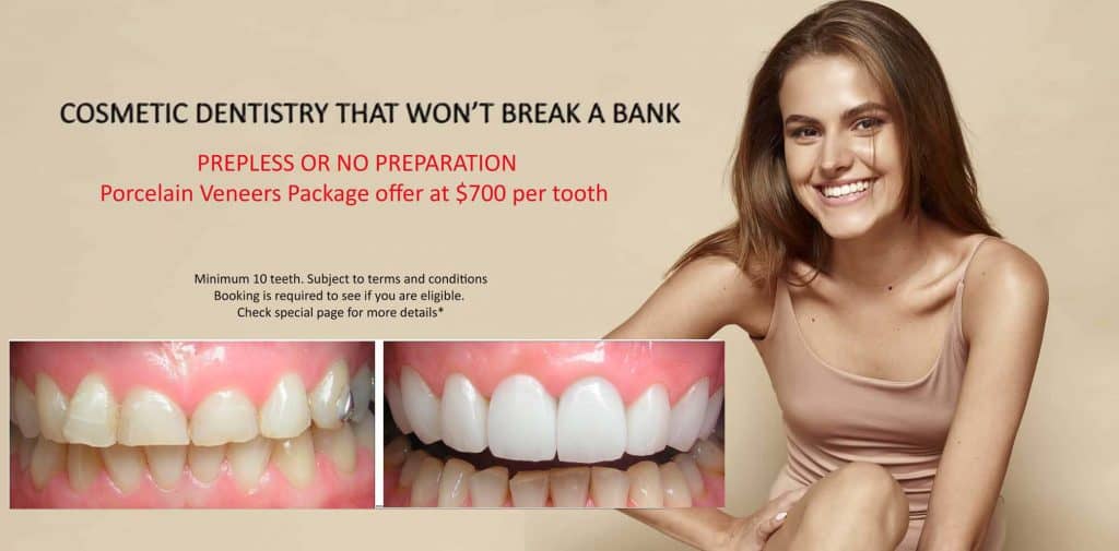 Porcelain Veneers Maintenance A Complete Guide