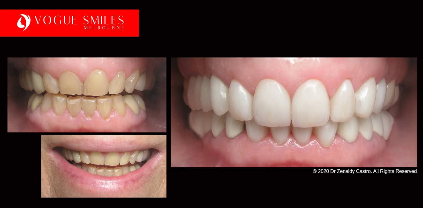 Porcelain Dental Crowns Melbourne City 3000 Victoria Australia