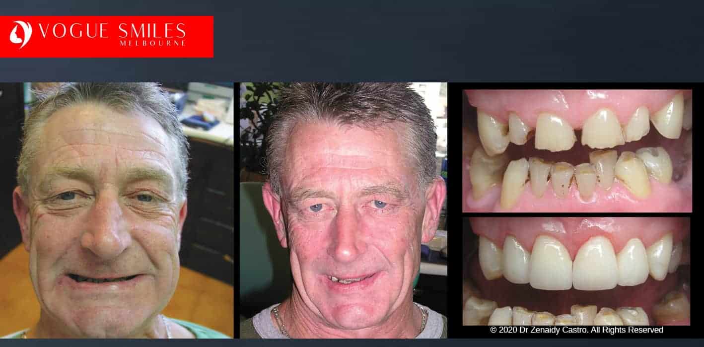 How to Repair Badly Damage Broken Tooth with Dental Crown Melbourne