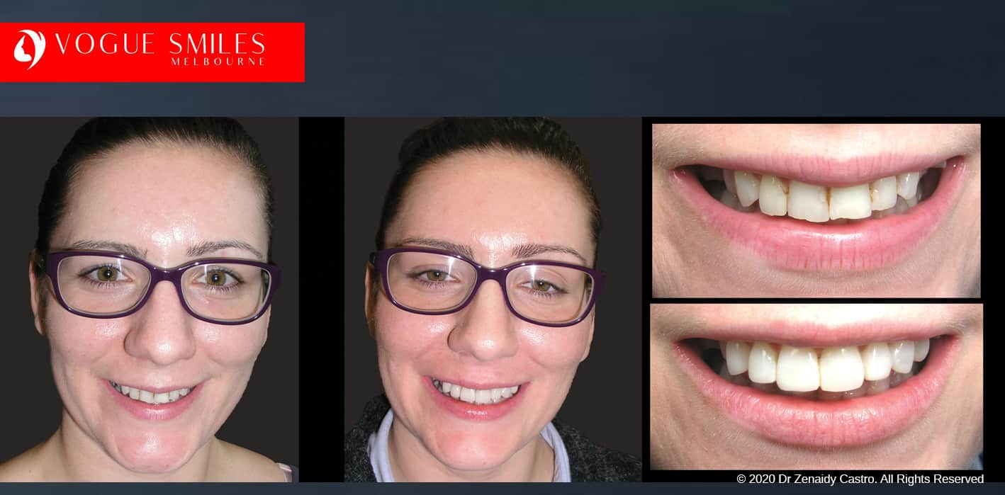 Smile Makeover Procedures Melbourne CBD Victoria Australia - Best Dentist Melbourne - Dr Zenaidy Castro - VOGUE SMILES MELBOURNE