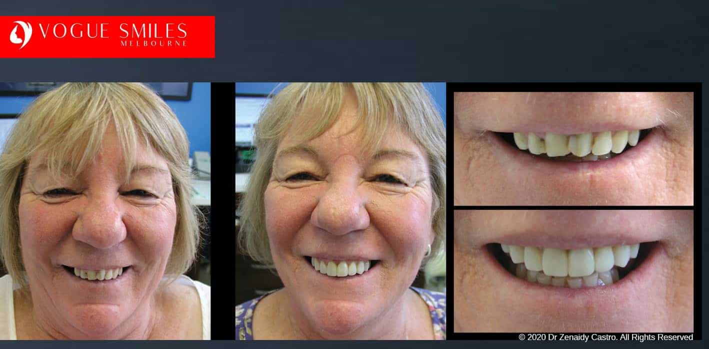 Composite Veneers Melbourne CBD, Composite Resin Bonding Melbourne CBD, Composite Bonding, Same day smile Melbourne CBD