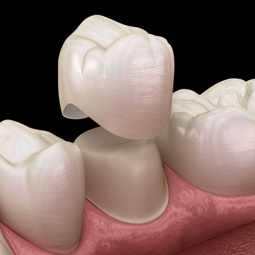 Porcelain Dental Crowns Melbourne City 3000 Victoria Australia