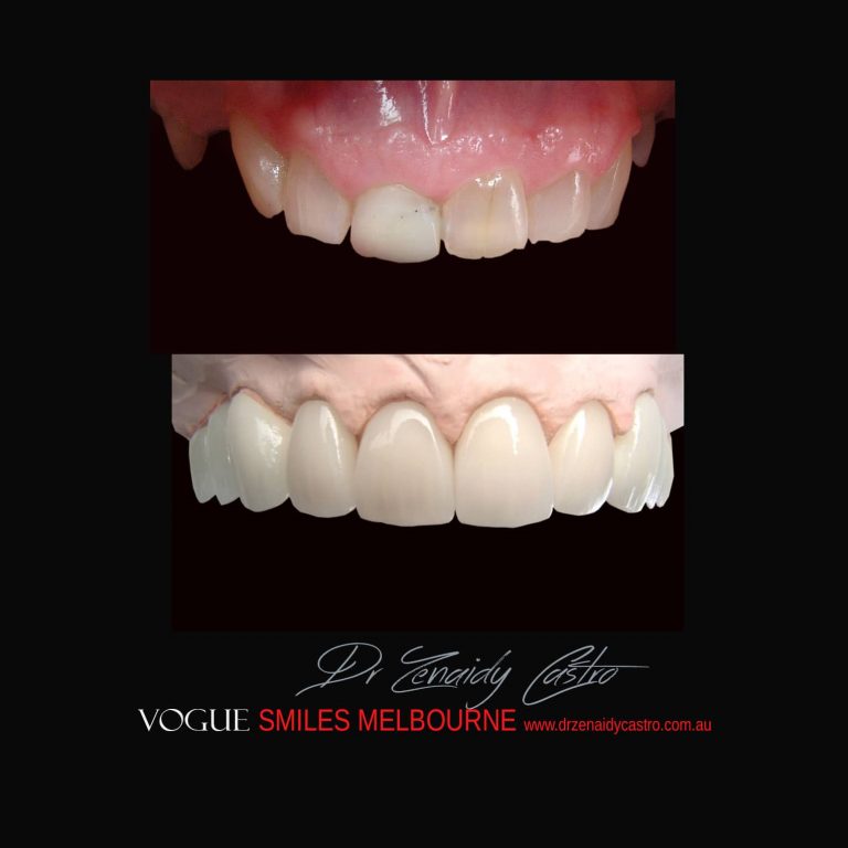 Top Cosmetic Dentist in Melbourne CBD before and after photo case study 62