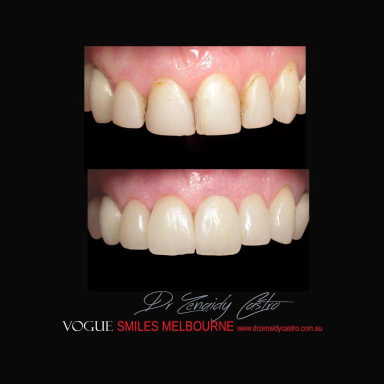 Top Cosmetic Dentist in Melbourne CBD before and after photo case study 59