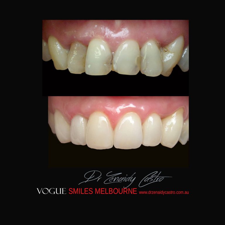 Top Cosmetic Dentist in Melbourne CBD before and after photo case study 52