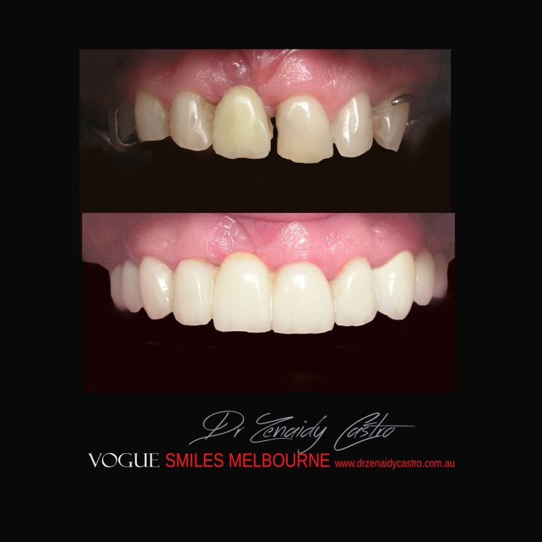 Top Cosmetic Dentist in Melbourne CBD before and after photo case study 50