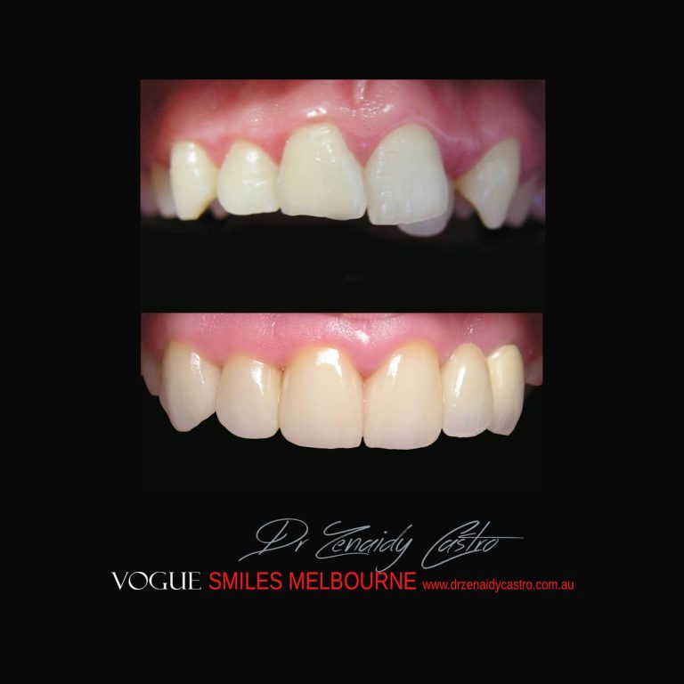 Top Cosmetic Dentist in Melbourne CBD before and after photo case study 48
