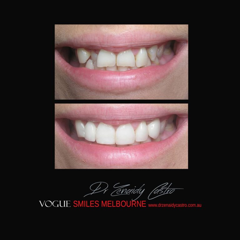 Top Cosmetic Dentist in Melbourne CBD before and after photo case study 47