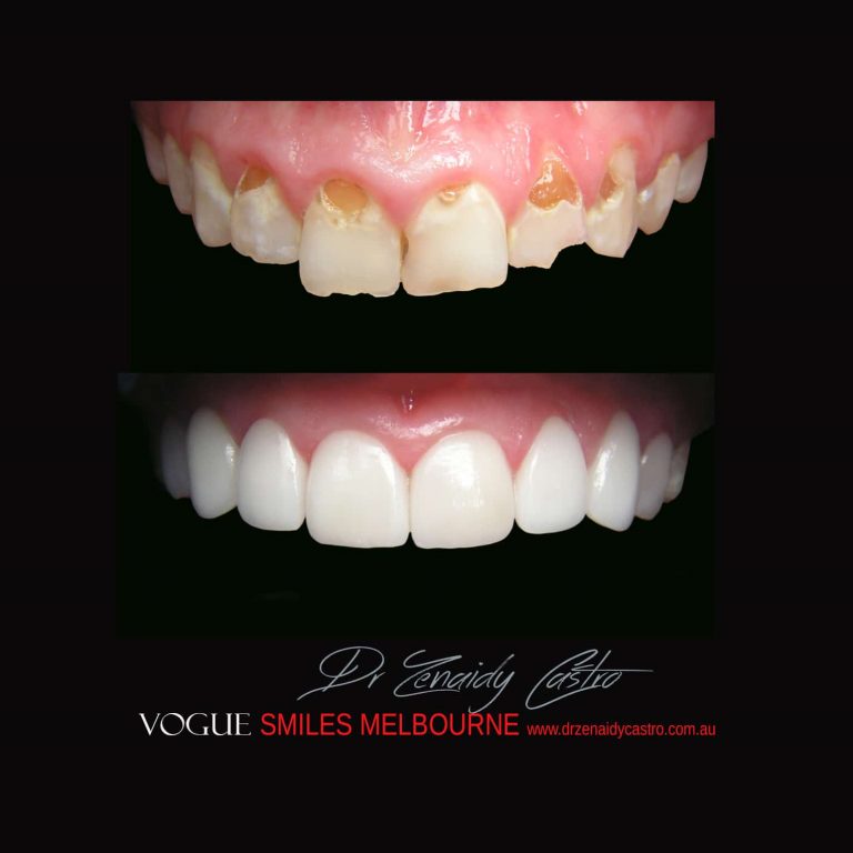 Top Cosmetic Dentist in Melbourne CBD before and after photo case study 43