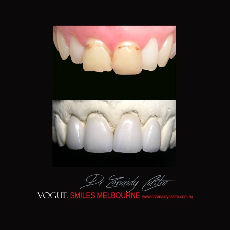 Top Cosmetic Dentist in Melbourne CBD before and after photo case study 41