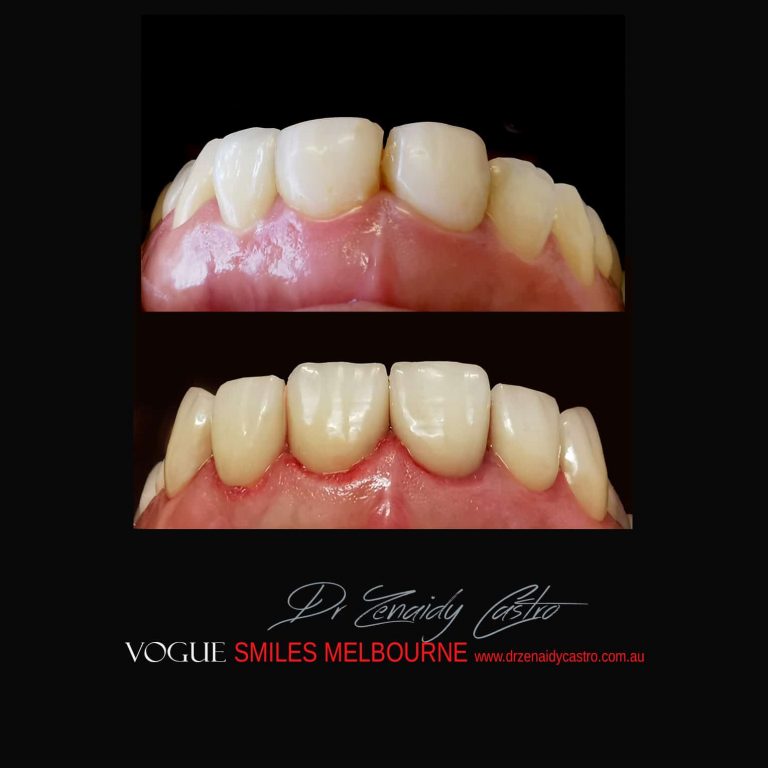 Top Cosmetic Dentist in Melbourne CBD before and after photo case study 40