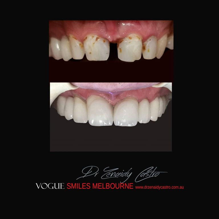 Top Cosmetic Dentist in Melbourne CBD before and after photo case study 32