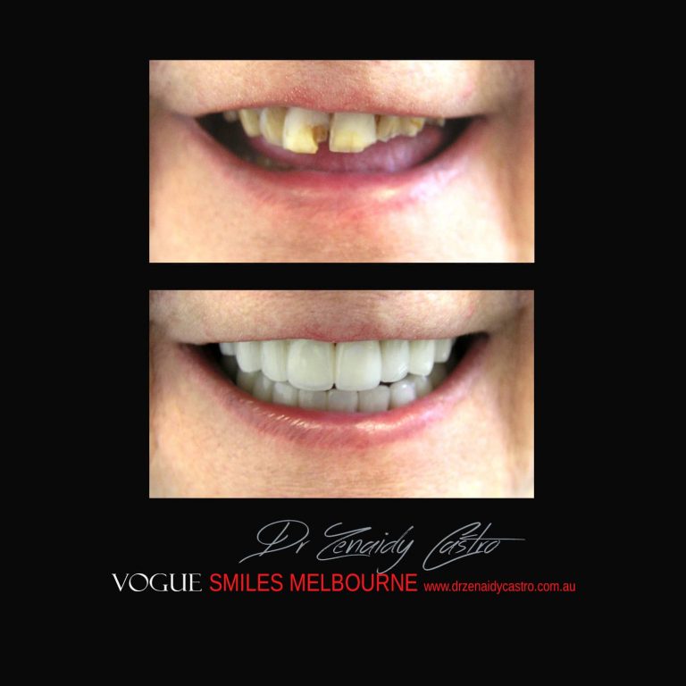 Top Cosmetic Dentist in Melbourne CBD before and after photo case study 31