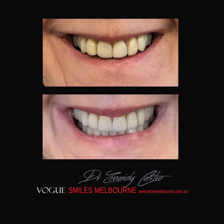 Top Cosmetic Dentist in Melbourne CBD before and after photo case study 29