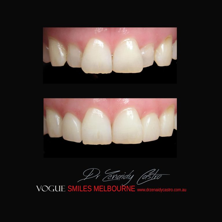 Top Cosmetic Dentist in Melbourne CBD before and after photo case study 28