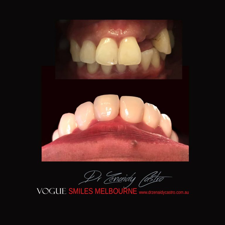 Top Cosmetic Dentist in Melbourne CBD before and after photo case study 25