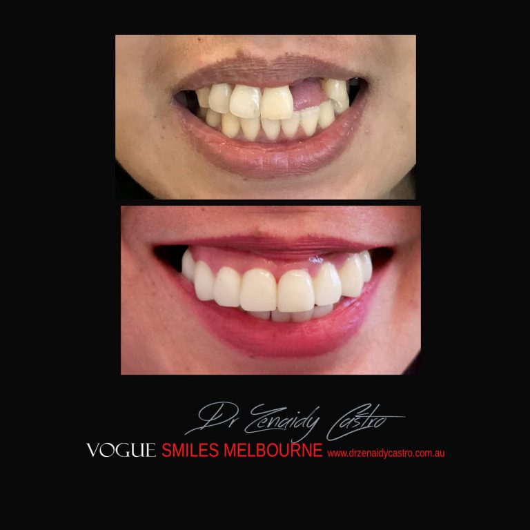 Top Cosmetic Dentist in Melbourne CBD before and after photo case study 24