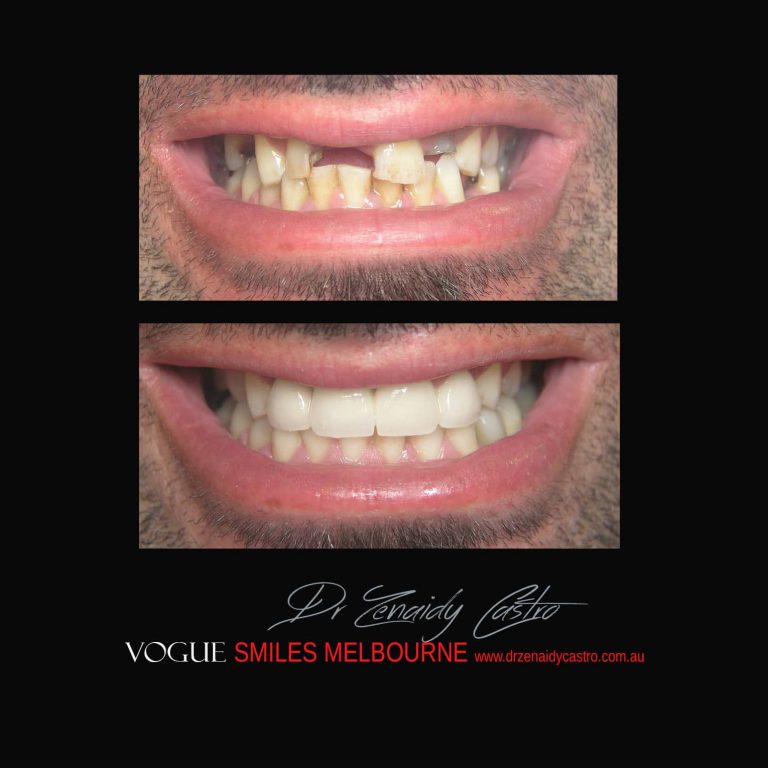 Top Cosmetic Dentist in Melbourne CBD before and after photo case study 17