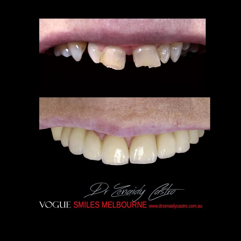 Top Cosmetic Dentist in Melbourne CBD before and after photo case study 68