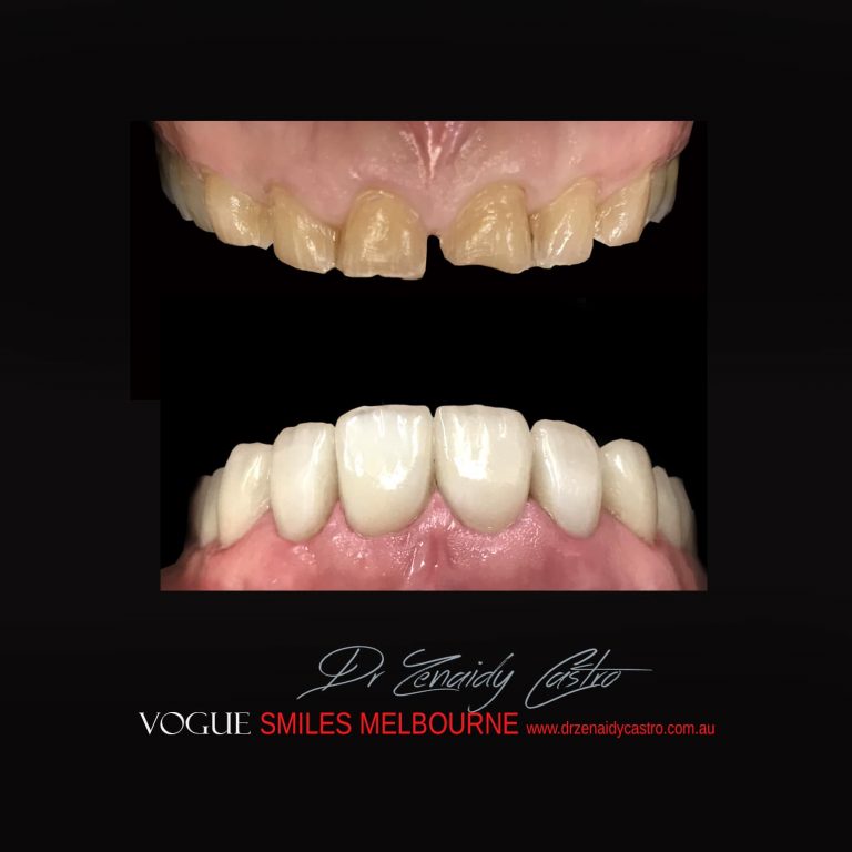 Top Cosmetic Dentist in Melbourne CBD before and after photo case study 14