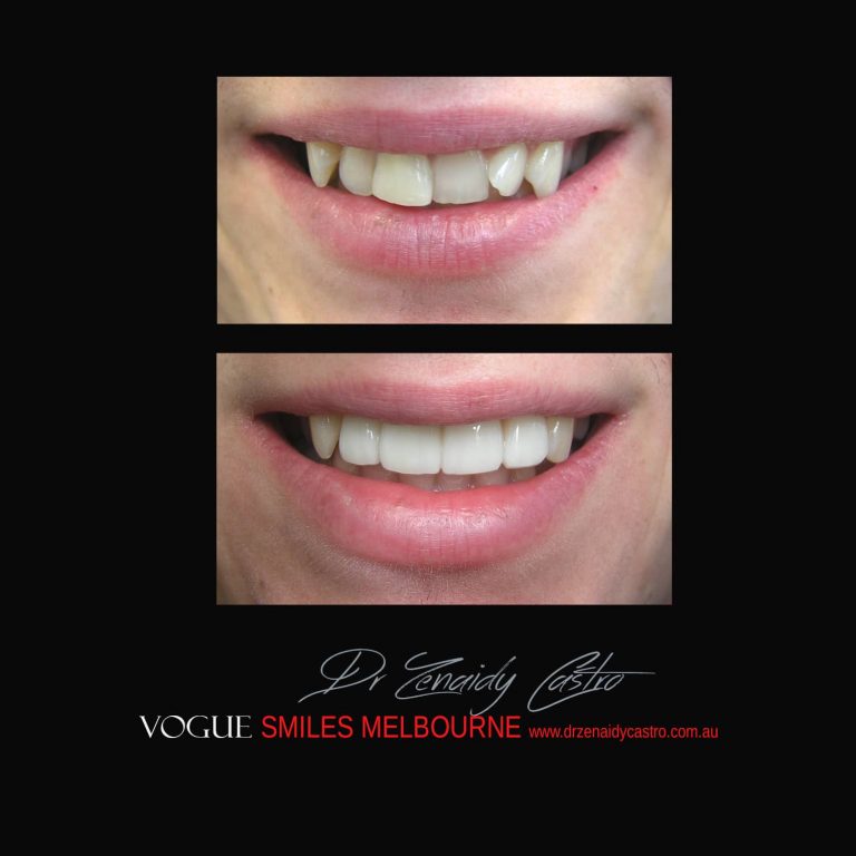 Top Cosmetic Dentist in Melbourne CBD before and after photo case study 13