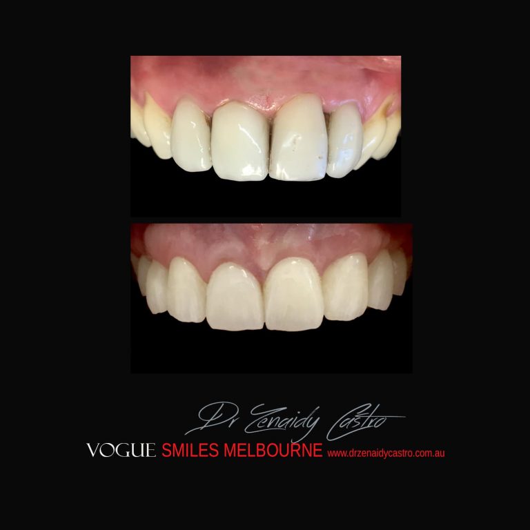 Top Cosmetic Dentist in Melbourne CBD before and after photo case study 12