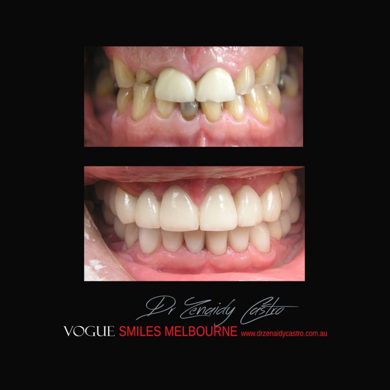 Top Cosmetic Dentist in Melbourne CBD before and after photo case study 4