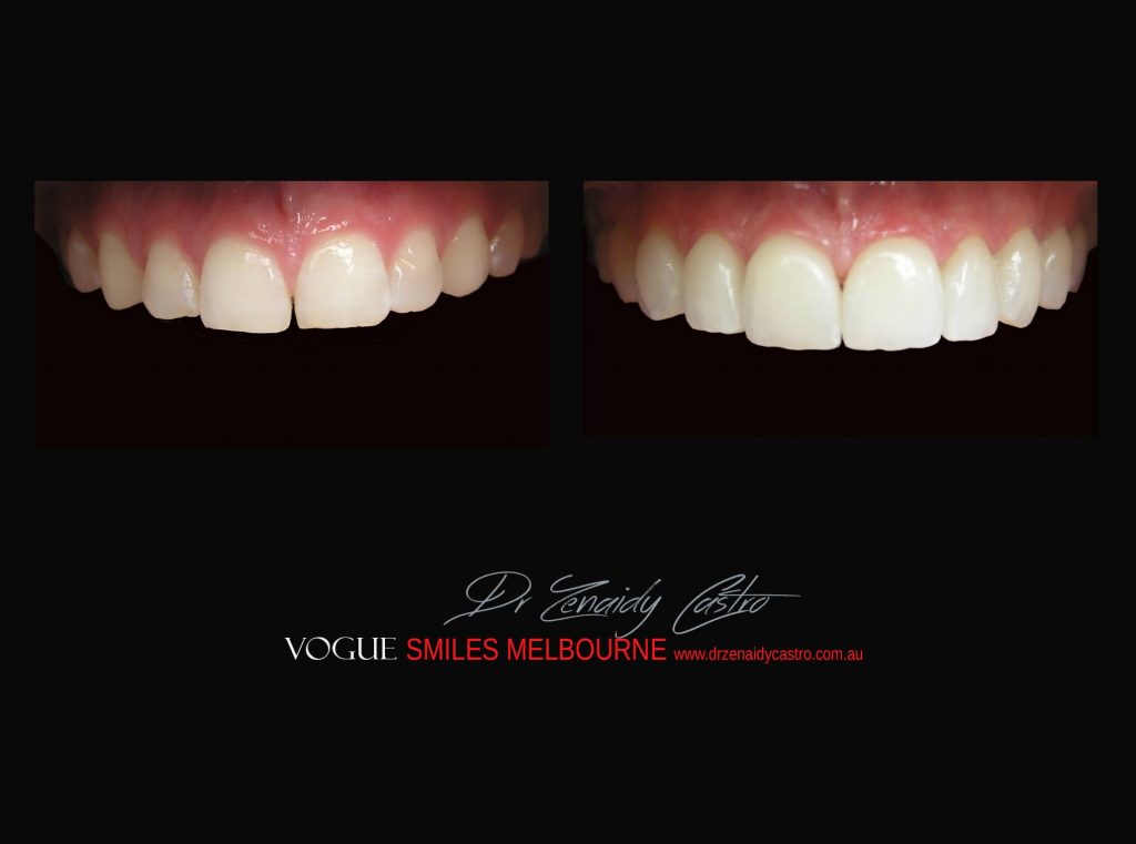 Top Cosmetic Dentist in Melbourne CBD before and after photo case study r82