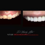 Top Cosmetic Dentist in Melbourne CBD before and after photo case study r73