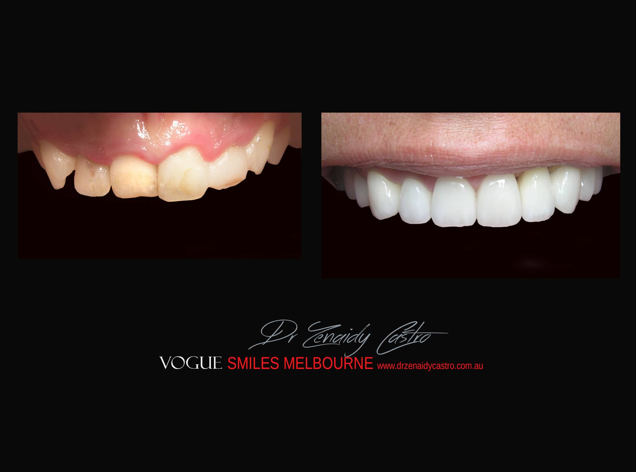Top Cosmetic Dentist in Melbourne CBD before and after photo case study r73
